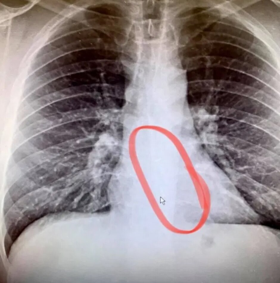 AirPods Stuck in Chest